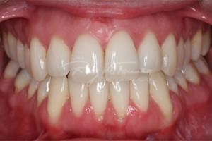 Invisalign-despues-frente