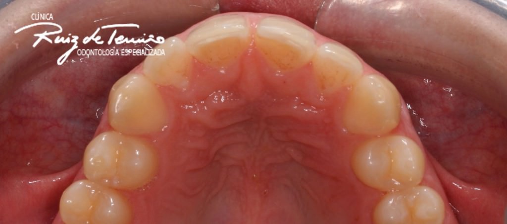 Invisalign-diastema-antes-sup