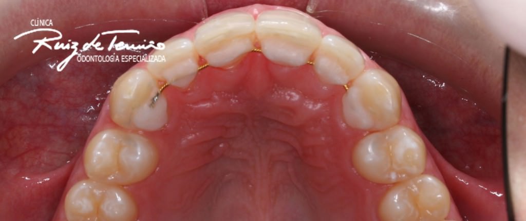 Invisalign-diastema-despues-sup