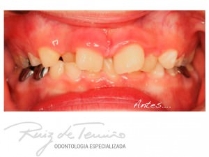 antes-despues-Victor-OGM