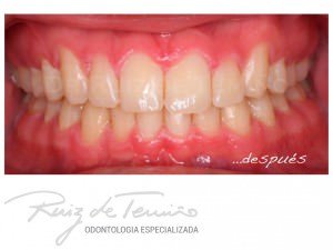 antes-despues-Victor-OGM-jpg