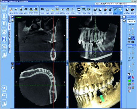 3D implante