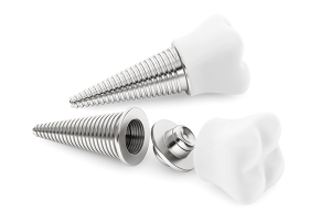Implantes