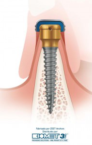 implantes2