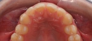 Invisalign diastema antes sup