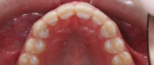 Invisalign diastema despues sup