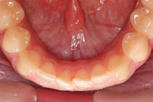 Invisalign dientes montados antes