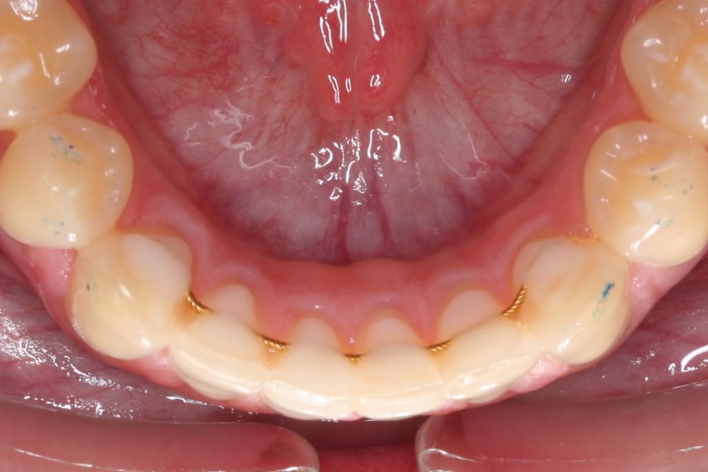 Invisalign dientes montados despues