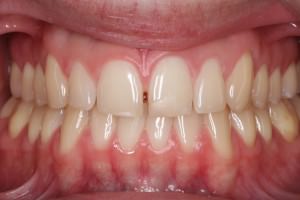 diastema antes