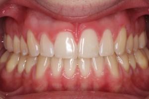 diastema despues