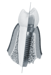implantes_ruizdetemino