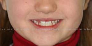 Mordida cruzada sonrisa antesMordida cruzada sonrisa antes