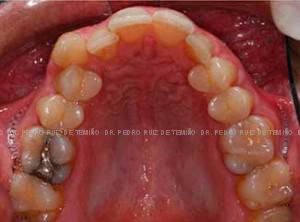 Ortodoncia lingual diseño sonrisa antes
