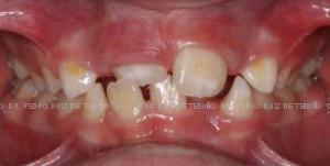 Dientes montados antes