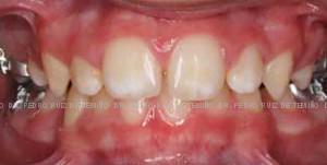 Dientes montados después