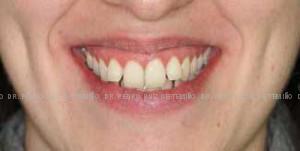 Invisalign antes