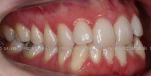 Invisalign antes dcha