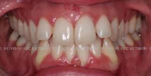 Invisalign antes frente