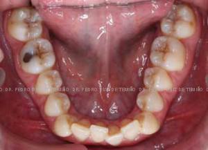 Invisalign apiñamiento antes