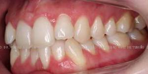 Invisalign. Apiñamiento antes