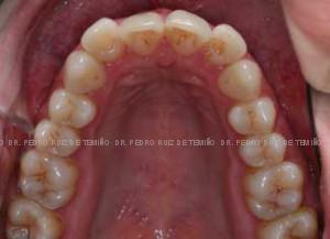 Invisalign apiñamiento antes