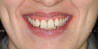 Invisalign antes