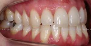 Invisalign despues dcha