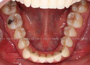 Invisalign apiñamiento después