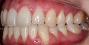 Invisalign despues izda