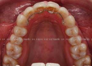 Invisalign apiñamiento después