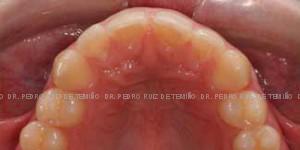 Invisalign diastema antes