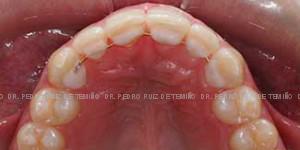 Invisalign diastema después