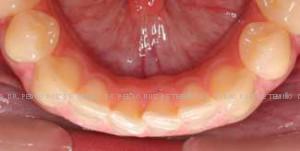 Invisalign dientes montados antes