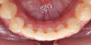 Invisalign dientes montados después
