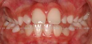 Mordida cruzada dientes pequeños antes