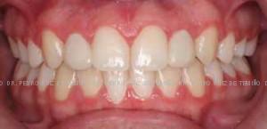 Mordida cruzada dientes pequeños después