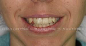 Ortodoncia Lingual. Mordida abierta y apiñamiento sonrisa antes