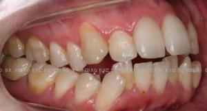Ortodoncia Lingual. Mordida abierta y apiñamiento lateral antes
