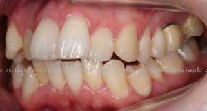 Ortodoncia Lingual. Mordida abierta y apiñamiento lateral antes