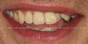 Ortodoncia lingual Sonrisa Antes