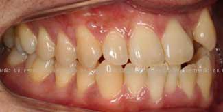 Ortodoncia-lingual-inicio-dcha