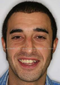 Ortodoncia lingual inicio extraoral