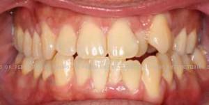 Ortodoncia-lingual-inicio-frente