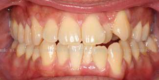 Ortodoncia-lingual-inicio-frente