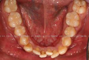 Ortodoncia-lingual-inicio-inf