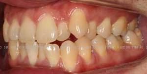 Ortodoncia-lingual-inicio-izda