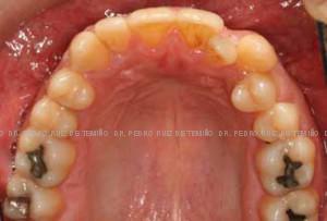 Ortodoncia-lingual-inicio-sup
