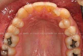 Ortodoncia-lingual-inicio-sup