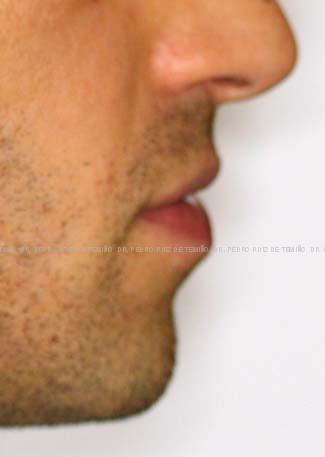 Ortodoncia lingual perfil antes