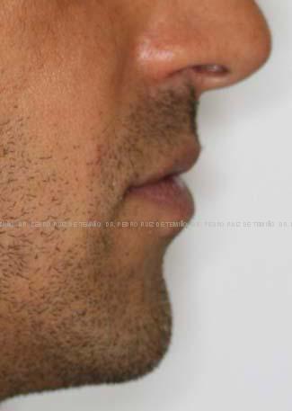 Ortodoncia lingual perfil despues